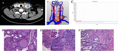 Single-Cell Transcriptomic Analysis of Ecosystems in Papillary Thyroid Carcinoma Progression